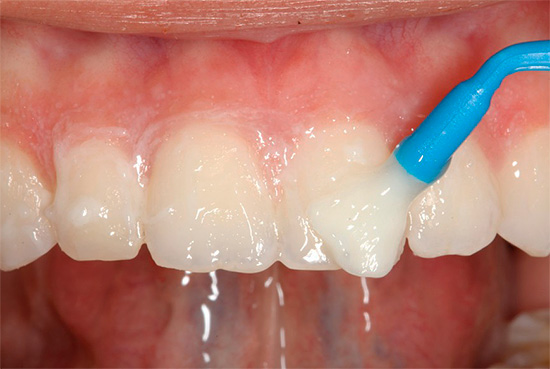 Se la carie colpisce solo lo smalto del dente da latte, allora il trattamento è spesso possibile senza l'uso di un trapano (mediante terapia rimineralizzante)