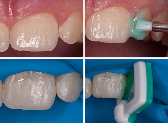 De afbeelding toont de tandheelkundige behandeling volgens de pictogramtechnologie.