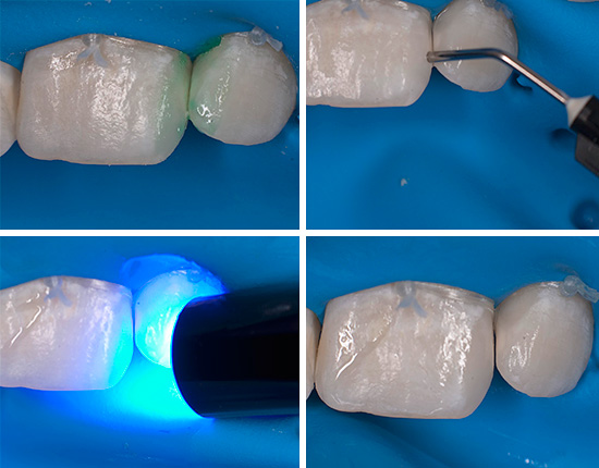 The final stages of treatment using Icon technology