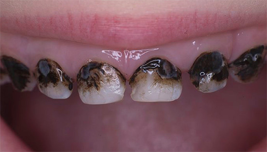 Así es como se ven los dientes de la leche después de la plata - francamente, lo que no es muy hermoso.