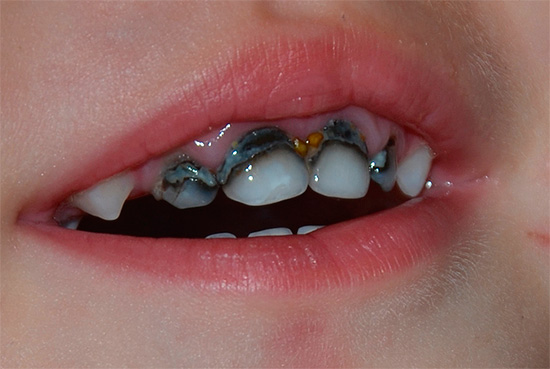 In addition to the aesthetic drawback, the silvering of teeth also has a generally low efficacy against caries.