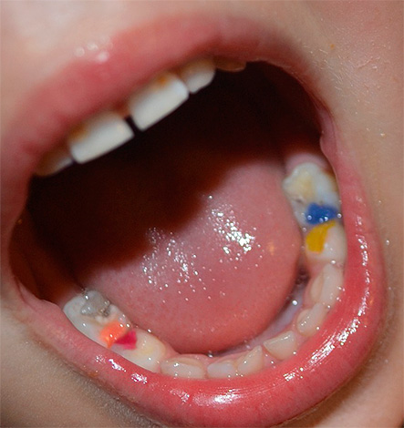 C’est ainsi que se présentent les obturations colorées sur les dents de lait. Parfois, les enfants aiment se montrer à leurs amis.