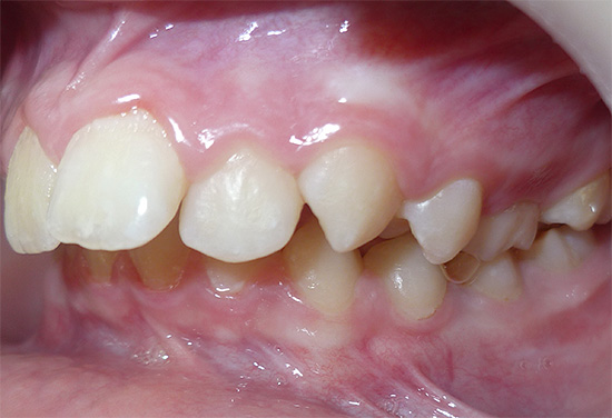 The photo shows another example of abnormal bite.