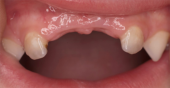 Outro problema associado a danos prematuros e graves nos dentes de leite pela cárie é a incapacidade da criança de mastigar os alimentos normalmente.