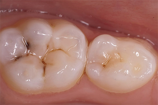 A foto mostra um exemplo de cárie de fissura em um dente de leite de mascar.