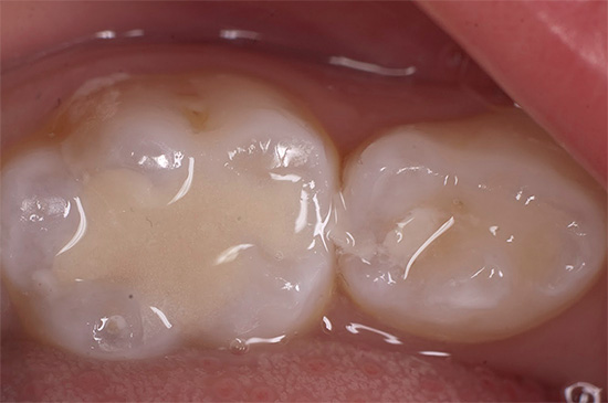 Και αυτό είναι το πώς ένα ήδη θεραπευμένο δόντι μωρού μοιάζει με μια γέμιση