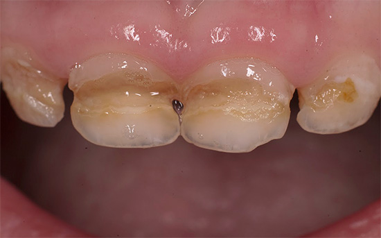 Ett exempel på flaskkaries: Föräldrar måste försöka att inte ta barnets tänder till ett sådant tillstånd och vid första tecken på förstörelse kontakta en tandläkare.