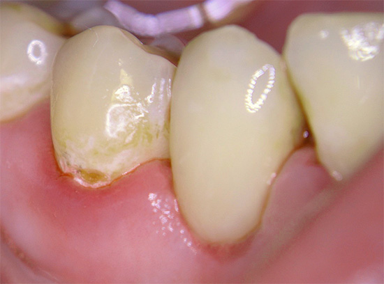 Servikal çürüklerin özellikleri ve dişlerdeki görünümünün ana nedenleri ile tanışıyoruz ...