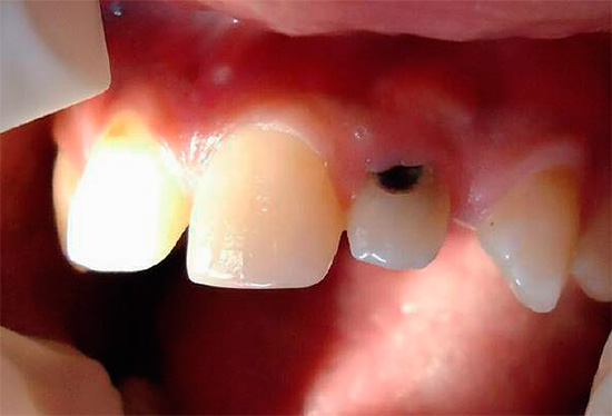 Another example of a deep carious lesion in the cervical region of the upper front tooth.