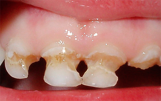 Circular caries of milk teeth