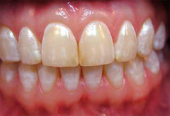 Con la fluorosis endémica, los dientes también pueden tener manchas de diferentes colores, desde el blanco hasta el marrón.