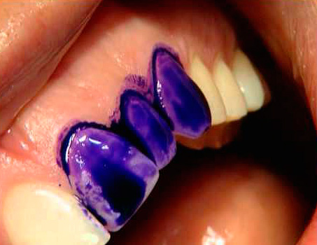 A special dye withstands only caries damaged by tooth decay, while with fluorosis and enamel hypoplasia, they remain unpainted when washing the staining solution.