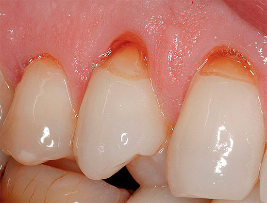 Das Foto zeigt ein Beispiel für keilförmige Defekte an den oberen Zähnen.