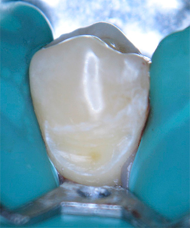 치료를 위해 자궁 경부 충치가있는 치아를 준비하는 예