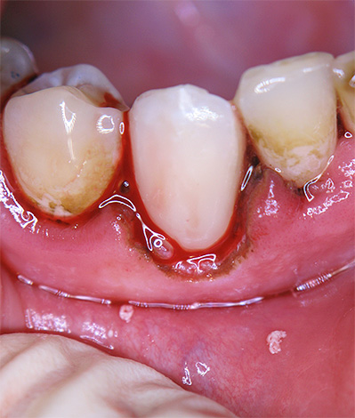 Het plaatsen van een verzegeling in het cervicale gebied kan aanzienlijk gecompliceerd worden door het binnendringen van vloeistof en bloed in het tandvleesveld.