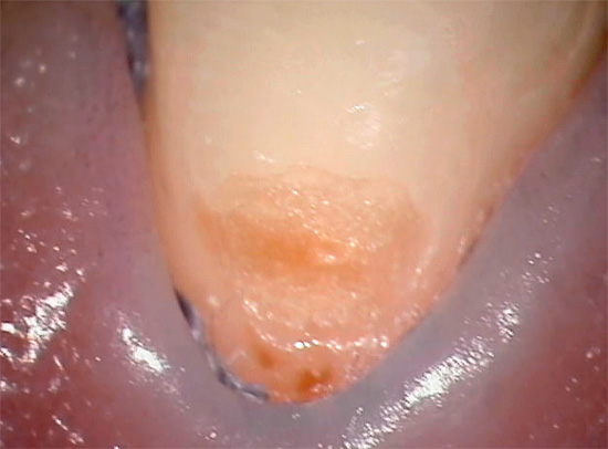 Нещо подобно може да изглежда като кариозно зъбно увреждане в цервикалната област в началния стадий на развитие.