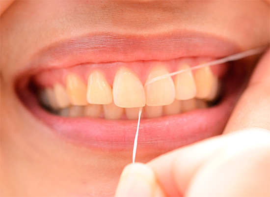 The use of dental floss allows you to effectively clean out the interdental space, where caries is often hidden.