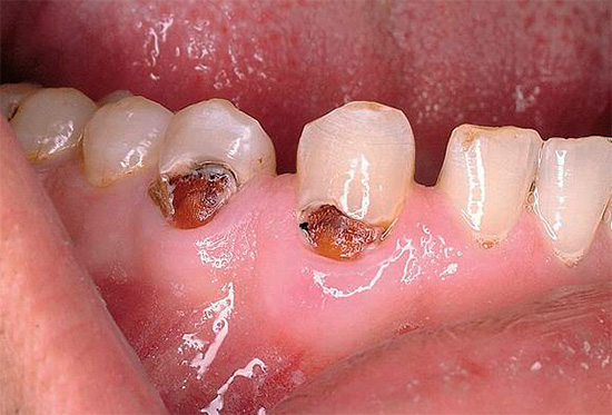 Och detta är ett mer försummat fall av livmoderhalsiga karies, när dentin ligger under emaljen påverkas.