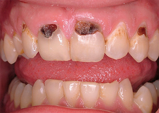 La carie cervicale sui denti anteriori può rovinare molto il sorriso di una persona.