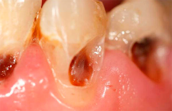 La foto muestra un ejemplo de caries cervicales profundas.