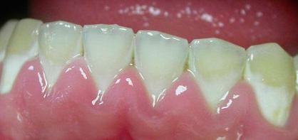 Cervical caries in the stage of white spot: at this stage it is necessary to urgently conduct remineralization therapy.