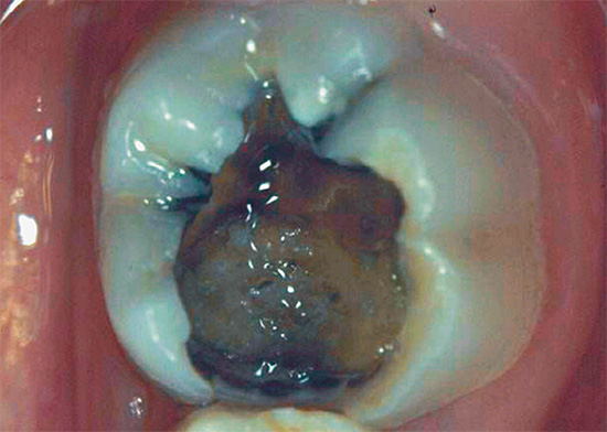 La photo montre un exemple de cavité carieuse profonde sur une dent à mâcher.
