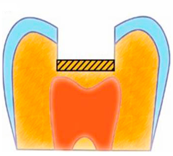 Pour protéger la pâte des effets toxiques des obturations au fond de la cavité, commencez par installer un joint isolant.