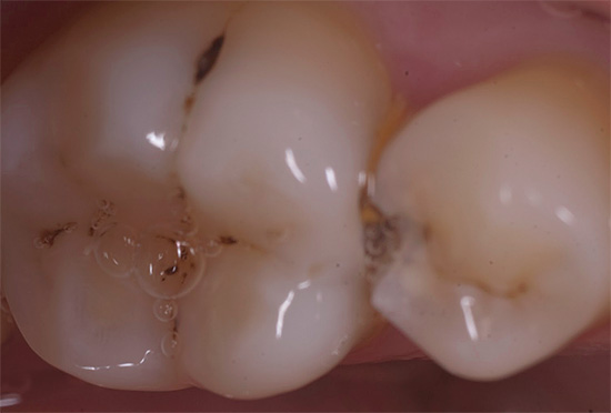 Caries profondes sur les surfaces de contact des dents