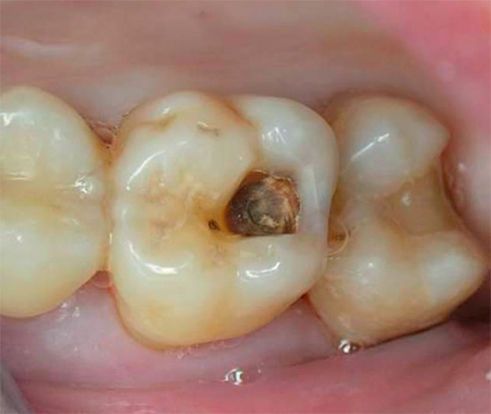En la caries crónica profunda, a pesar de la extensa destrucción del dolor de diente a veces no puede ser en absoluto.