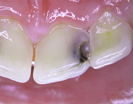 La foto muestra caries profundas en los dientes frontales.