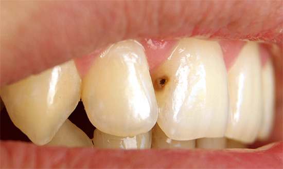 Carie profonde sur la dent antérieure