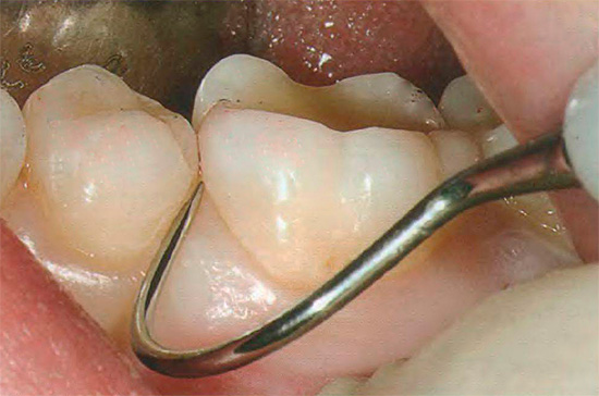 Un médico experimentado puede determinar la presencia de caries con una sonda dental.