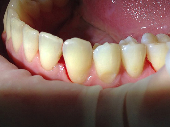 La foto muestra un diente con un defecto gingival antes del tratamiento.