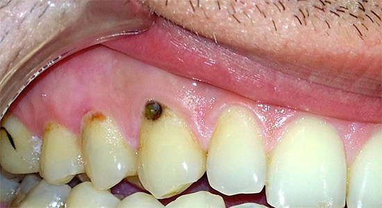 Souvent, les lésions carieuses du ciment de la racine de la dent sont associées à des caries cervicales.