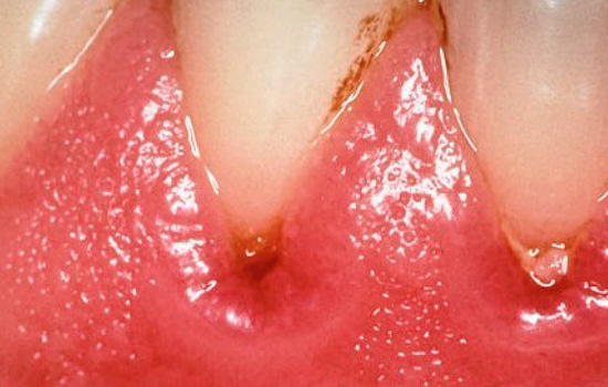 El desarrollo de microorganismos en el bolsillo entre la encía y el diente conduce a la inflamación de los tejidos blandos.