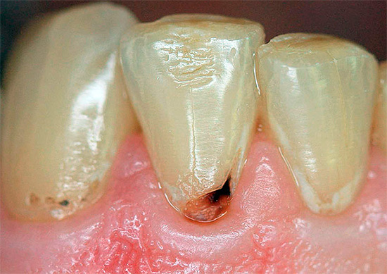 Caries cervical