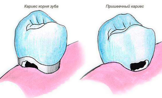 La imagen muestra la diferencia entre la caries cervical y la destrucción cariosa de la raíz del diente.