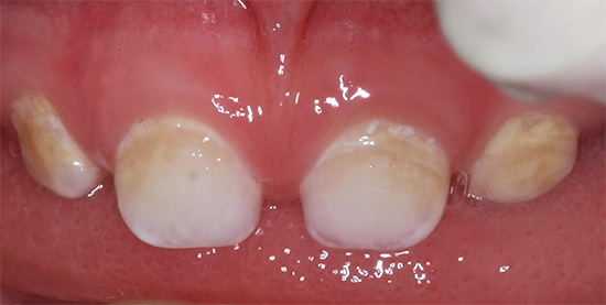 Y así, la caries de los dientes primarios se ve en la etapa inicial del desarrollo: aún no hay cavidades cariosas profundas, pero el esmalte ya está fuertemente desmineralizado.