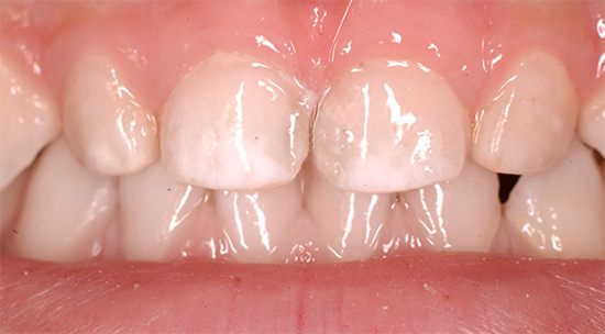 Un ejemplo de esmalte de los dientes de leche que se ha blanqueado debido a la desmineralización.