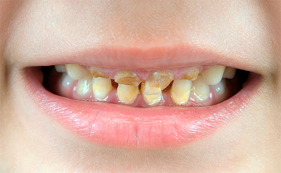 Como regla general, en ausencia de una higiene oral adecuada, la caries infecta muchos de los dientes de leche del bebé.