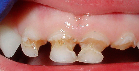 Avec cet état des dents, leur partie coronale peut facilement se rompre.