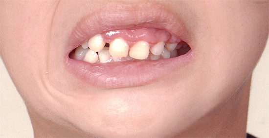 La pérdida prematura de los dientes de leche a menudo conlleva una violación de la mordedura e incluso un cambio en la forma de la cara.