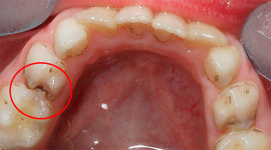 Con caries profundas, el dolor en los dientes de leche puede ocurrir incluso por contacto mecánico simple con alimentos sólidos.