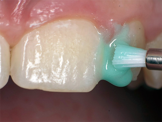 Hoy en día, la llamada tecnología ICON, que no requiere preparación dental mediante un taladro, se usa ampliamente para tratar la caries en la etapa de tinción.