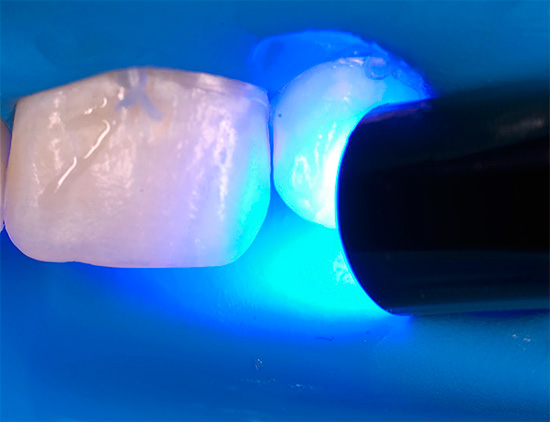 El polímero aplicado es curado por ultravioleta.