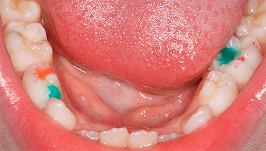 L'utilisation de plombages colorés dans les dents de lait permet à l'enfant de s'intéresser et de motiver le traitement.