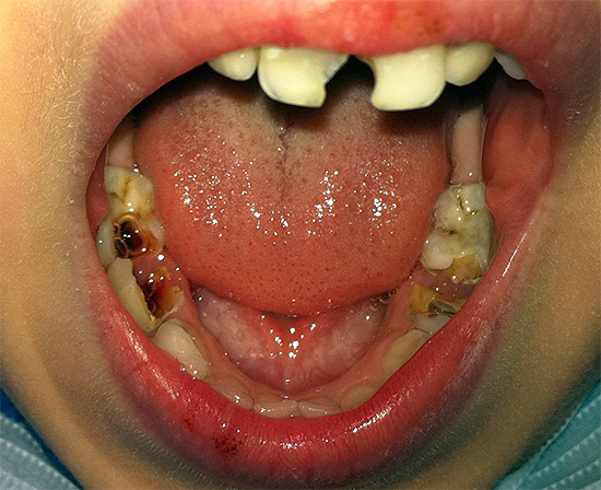 Et voici un cas plus grave, lorsque la parodontite complique déjà la carie.
