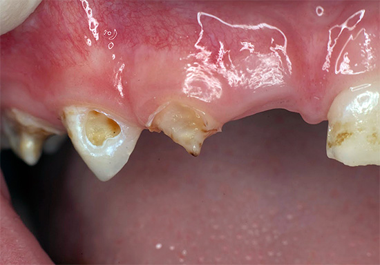 La foto muestra un ejemplo de caries desatendidas de los dientes de leche.