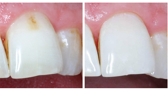 Voici comment se présente la dent antérieure avant et après traitement avec la technologie Ikon.