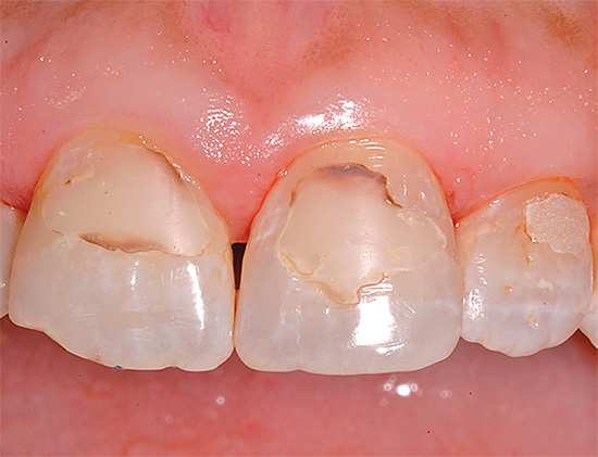 La foto muestra un ejemplo de caries secundarias en los dientes frontales debajo de los rellenos.